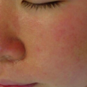 「化粧水」低刺激◎赤らみ・痒みケア！≪脂漏性皮膚炎用≫化粧水モニター大募集（377）の投稿画像