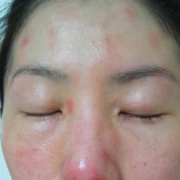 「顔出しＯＫです！」低刺激◎赤らみ・痒みケア！≪脂漏性皮膚炎用≫化粧水モニター大募集（377）の投稿画像