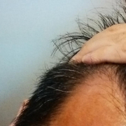 「生え際が」低刺激◎赤らみ・痒みケア！≪脂漏性皮膚炎用≫化粧水モニター大募集（377）の投稿画像