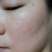 「中学生くらいから」低刺激◎赤らみ・痒みケア！≪脂漏性皮膚炎用≫化粧水モニター大募集（377）の投稿画像