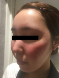 「使用後3日目の肌です。」の画像（2枚目）