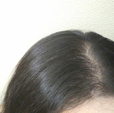 「薄毛」の画像（1枚目）