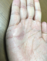 口コミ記事「ハイドロコロイド絆創膏」の画像