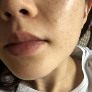 「シミと肌荒れ」＜商品PRモデルとして活躍！＞肌悩みのある方で撮影に参加頂ける方大募集！！の投稿画像