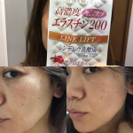 アラフォーBBA。コロナでストレス溜まる時こそエイジング対策として、モニターに挑戦。2週間だけど、中々の効果。写真の角度にもよるけど、左がサプリ摂る前で、右の方が2週間後。引き締まってる👏👏*&hellip;のInstagram画像