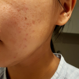 「顔写真と開き毛穴の写真」の画像（2枚目）