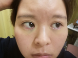 逆さまつげ手術しました