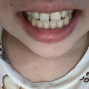 「ビフォーアフターが楽しみ！」【薬用美白】歯磨きジェル☆ビフォーアフター投稿モニター20名様　募集！の投稿画像