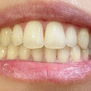 「歯」【薬用美白】歯磨きジェル☆ビフォーアフター投稿モニター20名様　募集！の投稿画像