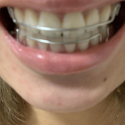 「使用前」【薬用美白】歯磨きジェル☆ビフォーアフター投稿モニター20名様　募集！の投稿画像