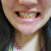 「もっとキレイな」【薬用美白】歯磨きジェル☆ビフォーアフター投稿モニター20名様　募集！の投稿画像