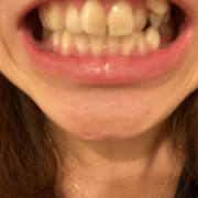 「白くなりたい！」【薬用美白】歯磨きジェル☆ビフォーアフター投稿モニター20名様　募集！の投稿画像