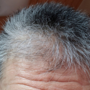 「気になる額のシワ」「シワ改善」無添加【薬用】オールインワンゲル☆ビフォーアフター投稿モニター20名様　募集！の投稿画像