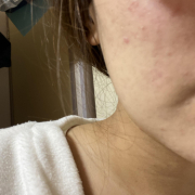 「ニキビ跡」★女優下地★を使って美肌に！画像投稿モニター募集！の投稿画像