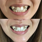 「デンタクリーンでホワイトニング」の画像（1枚目）