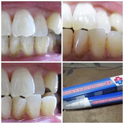 口コミ：ホワイトニングデンタブラッシュEX使用報告の画像（1枚目）