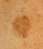 シミにききますよーに✩.*˚