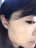 頬の高い所にシミができ始めました