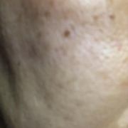 「色素沈着」★画像投稿★お顔の気になる「シミ」「黒ずみ」に！ピンポイント美白パックを使って景品をゲット～！の投稿画像