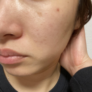 「頬のしみ」★画像投稿★お顔の気になる「シミ」「黒ずみ」に！ピンポイント美白パックを使って景品をゲット～！の投稿画像