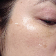 「大き目のシミふたつ」★画像投稿★お顔の気になる「シミ」「黒ずみ」に！ピンポイント美白パックを使って景品をゲット～！の投稿画像
