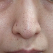 「鼻の毛穴の黒ずみ」★画像投稿★お顔の気になる「シミ」「黒ずみ」に！ピンポイント美白パックを使って景品をゲット～！の投稿画像