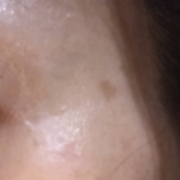 「右のこめかみ」★画像投稿★お顔の気になる「シミ」「黒ずみ」に！ピンポイント美白パックを使って景品をゲット～！の投稿画像