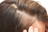 薄毛や白髪