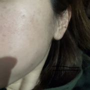 「シミや赤みのある肌です。」★新商品モニター★ファンデ級カバー力の薬用美白美容液を使って画像投稿～の投稿画像