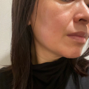 「顔の赤みが気になっています。」★新商品モニター★ファンデ級カバー力の薬用美白美容液を使って画像投稿～の投稿画像