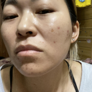 「ニキビ」★新商品モニター★ファンデ級カバー力の薬用美白美容液を使って画像投稿～の投稿画像
