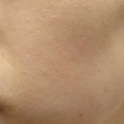 「頬にある大人ニキビと乾燥による肌荒れとくすみに悩んでいます」★新商品モニター★ファンデ級カバー力の薬用美白美容液を使って画像投稿～の投稿画像