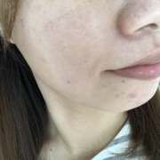 「改善したい！」★新商品モニター★ファンデ級カバー力の薬用美白美容液を使って画像投稿～の投稿画像