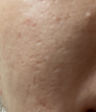 「開き毛穴用美容液ソワン使用後の感想」の画像（2枚目）