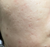 「開き毛穴用美容液ソワン使用後の感想」の画像（3枚目）