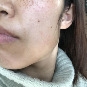 「そばかす」「シワ改善」無添加【薬用】オールインワンゲル☆ビフォーアフター投稿モニター30名様　募集！の投稿画像