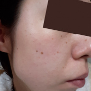 「シミを少しでも薄くしたいです！」【何が届くかはお楽しみ★】シミにお悩み方、レビュー上手な方に♪商品体験モニター60名募集！の投稿画像
