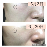 シュワトレーゼ薬用リンクルホワイトゲル1.5ヶ月経過！