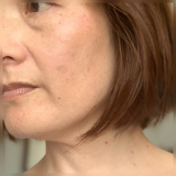 黒ずみ&そばかすの悩み