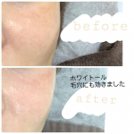 ❀ホワイトール経過報告飲む美白ケアをしばらく使い続けた結果が凄かったので投稿します✨美白効果はもちろんのこと、肌のキメが整って毛穴にも効きました！ビタミン🍋も入っているからかな&hellip;のInstagram画像