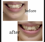 「1ヶ月間のホワイトニング」の画像（1枚目）