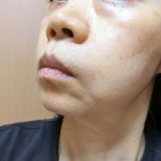 「これ一つの手軽さで、シミもシワもまとめてケア」＼モニター満足度97％／「シワ改善」無添加【薬用】オールインワンゲル☆ビフォーアフター投稿モニター30名様　募集！の投稿画像