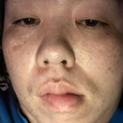 「頬と鼻周りが特に酷いです」＼モニター満足度97％／「シワ改善」無添加【薬用】オールインワンゲル☆ビフォーアフター投稿モニター30名様　募集！の投稿画像