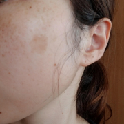 「しみ、そばかす」＼モニター満足度97％／「シワ改善」無添加【薬用】オールインワンゲル☆ビフォーアフター投稿モニター30名様　募集！の投稿画像