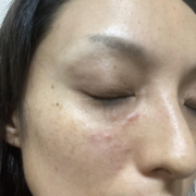 「目元とほうれい線のシワが気になります」＼モニター満足度97％／「シワ改善」無添加【薬用】オールインワンゲル☆ビフォーアフター投稿モニター30名様　募集！の投稿画像