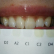 「今の状態...」【新商品】美白歯みがきジェルを使って画像投稿をしてくれる方30名募集★の投稿画像