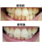 シーヴァ　デンタブラッシュEXマウスピース矯正をしています。歯の黄ばみが気になっていましたが、いつもの歯みがき後にブラッシングを朝晩ひと月続けたらトーンアップできました。研磨剤を使わずにツ&hellip;のInstagram画像