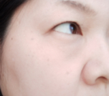 「頬のシミ、くすみ」の画像（1枚目）