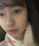 シミはもちろんニキビ跡まで！