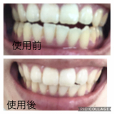 薬用ホワイトニング デンタブラッシュEX 　 - xiva　シーヴァ -
